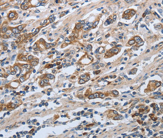 Immunohistochemistry of paraffin-embedded Human gasrtic cancer tissue using SLC34A2 Polyclonal Antibody at dilution of 1:50