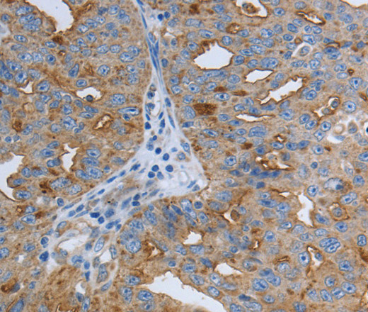 Immunohistochemistry of paraffin-embedded Human ovarian cancer using SLC34A2 Polyclonal Antibody at dilution of 1:50