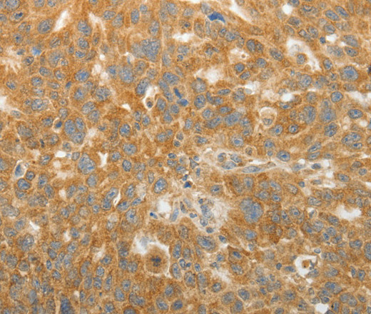 Immunohistochemistry of paraffin-embedded Human ovarian cancer tissue using GEMIN2 Polyclonal Antibody at dilution 1:40