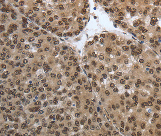 Immunohistochemistry of paraffin-embedded Human liver cancer tissue using SMAD7 Polyclonal Antibody at dilution 1:40