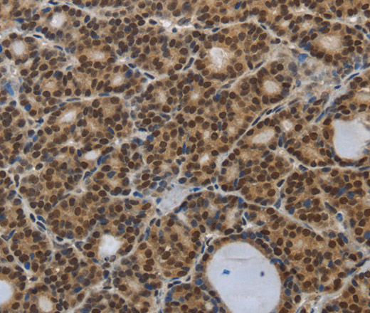 Immunohistochemistry of paraffin-embedded Human thyroid cancer tissue using SMAD7 Polyclonal Antibody at dilution 1:40