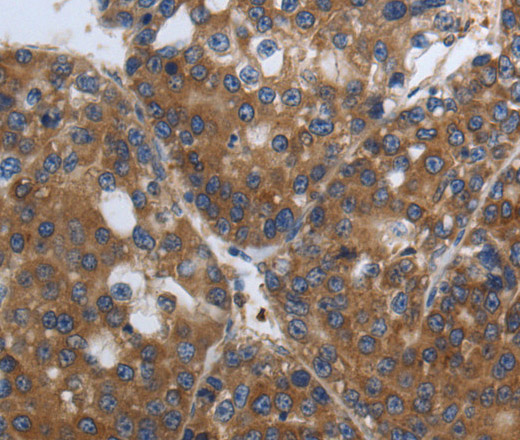 Immunohistochemistry of paraffin-embedded Human liver cancer using SOCS1 Polyclonal Antibody at dilution of 1:90