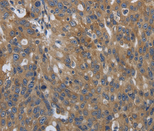 Immunohistochemistry of paraffin-embedded Human ovarian cancer using SOCS1 Polyclonal Antibody at dilution of 1:90