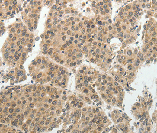 Immunohistochemistry of paraffin-embedded Human liver cancer tissue using SOCS7 Polyclonal Antibody at dilution 1:30