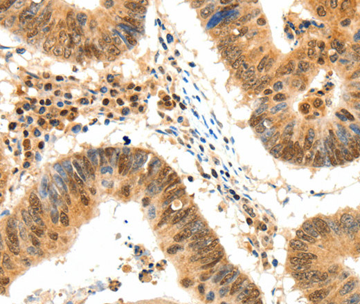 Immunohistochemistry of paraffin-embedded Human colon cancer tissue using TERF2 Polyclonal Antibody at dilution 1:50