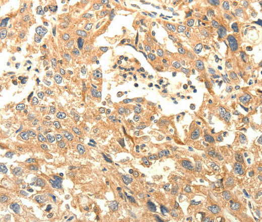 Immunohistochemistry of paraffin-embedded Human esophagus cancer tissue using AGRN Polyclonal Antibody at dilution of 1:30