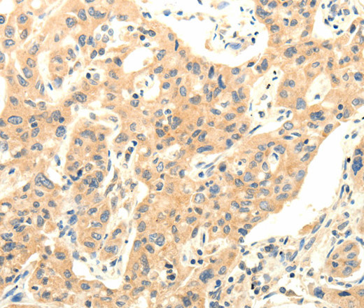 Immunohistochemistry of paraffin-embedded Human lung cancer using AGRN Polyclonal Antibody at dilution of 1:30