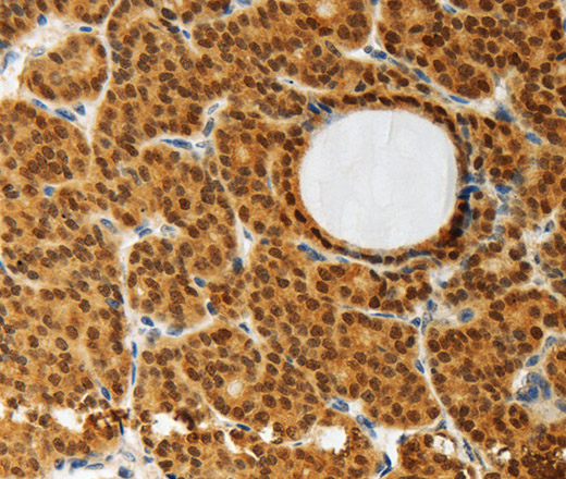 Immunohistochemistry of paraffin-embedded Human thyroid cancer using AKR1A1 Polyclonal Antibody at dilution of 1:30