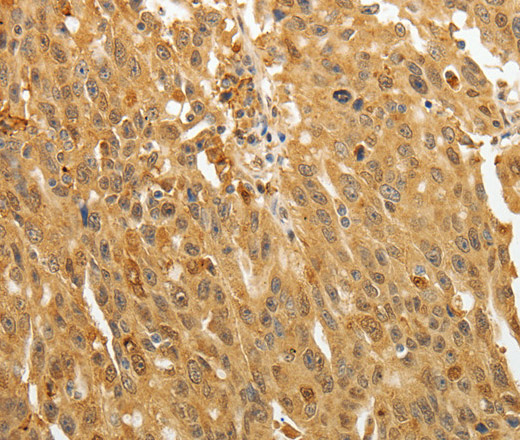 Immunohistochemistry of paraffin-embedded Human ovarian cancer using AKR1A1 Polyclonal Antibody at dilution of 1:30