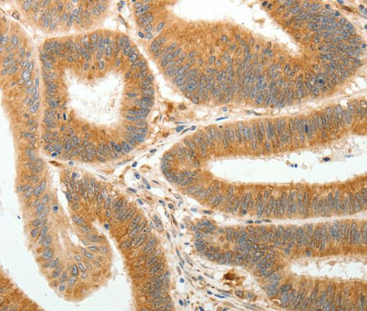 Immunohistochemistry of paraffin-embedded Human colon cancer using AKR1B1 Polyclonal Antibody at dilution of 1:30