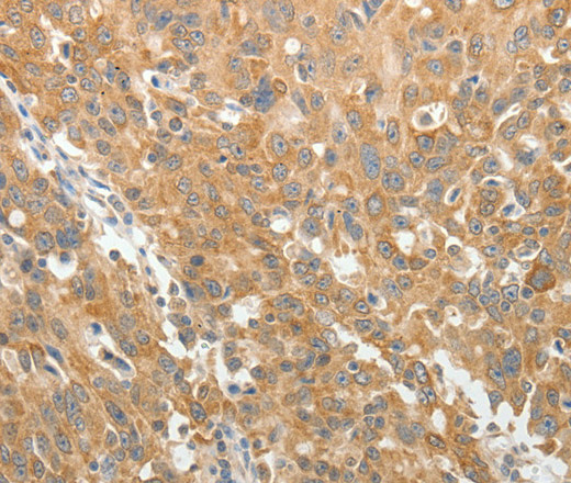 Immunohistochemistry of paraffin-embedded Human ovarian cancer using AKR1B1 Polyclonal Antibody at dilution of 1:30