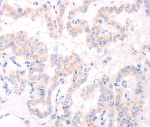 Immunohistochemistry of paraffin-embedded Human thyroid cancer tissue using AMH Polyclonal Antibody at dilution 1:30