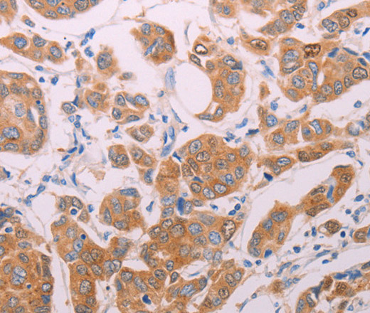 Immunohistochemistry of paraffin-embedded Human breast cancer using AGT Polyclonal Antibody at dilution of 1:30