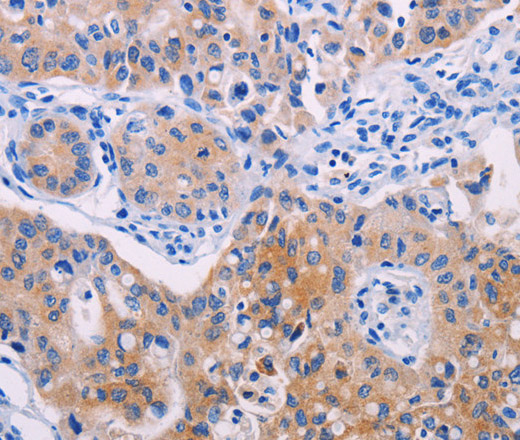 Immunohistochemistry of paraffin-embedded Human lung cancer using AGT Polyclonal Antibody at dilution of 1:30