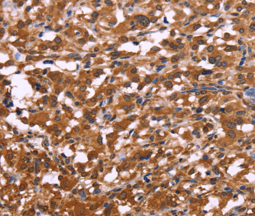 Immunohistochemistry of paraffin-embedded Human thyroid cancer using APMAP Polyclonal Antibody at dilution of 1:30