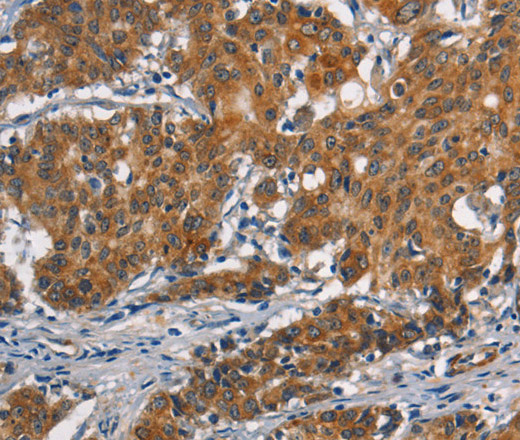 Immunohistochemistry of paraffin-embedded Human gastic cancer using APOL1 Polyclonal Antibody at dilution of 1:40