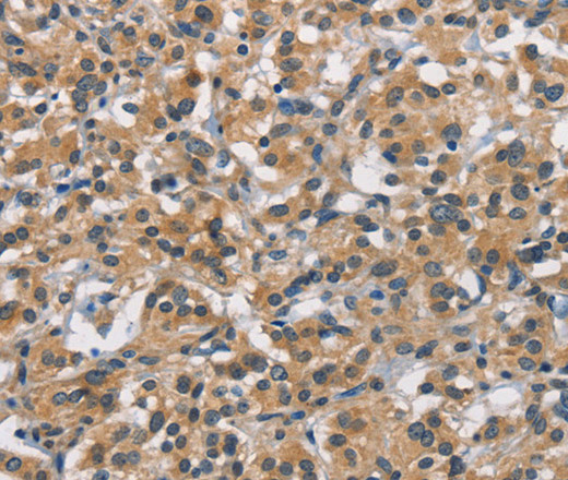 Immunohistochemistry of paraffin-embedded Human thyroid cancer using APOL1 Polyclonal Antibody at dilution of 1:40