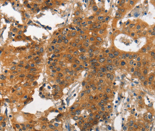 Immunohistochemistry of paraffin-embedded Human gastic cancer using ITGA2 Polyclonal Antibody at dilution of 1:30