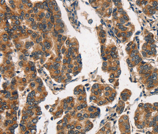 Immunohistochemistry of paraffin-embedded Human breast cancer using ITGA2 Polyclonal Antibody at dilution of 1:30