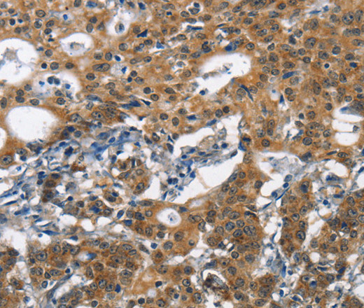 Immunohistochemistry of paraffin-embedded Human gasrtic cancer tissue using DCC Polyclonal Antibody at dilution 1:70