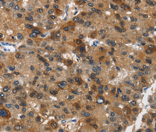 Immunohistochemistry of paraffin-embedded Human liver cancer tissue using DCC Polyclonal Antibody at dilution 1:70