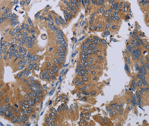 Immunohistochemistry of paraffin-embedded Human colon cancer using PRKD3 Polyclonal Antibody at dilution of 1:50