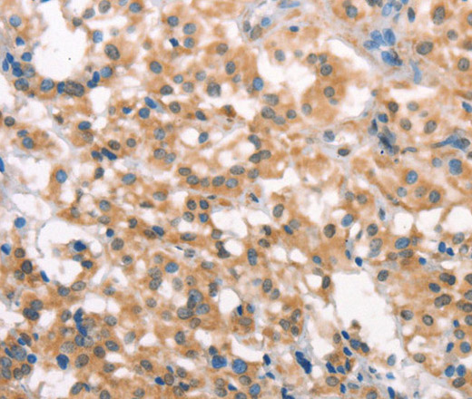 Immunohistochemistry of paraffin-embedded Human thyroid cancer tissue using LATS2 Polyclonal Antibody at dilution 1:30