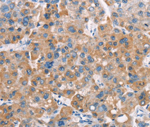 Immunohistochemistry of paraffin-embedded Human liver cancer tissue using LATS2 Polyclonal Antibody at dilution 1:30