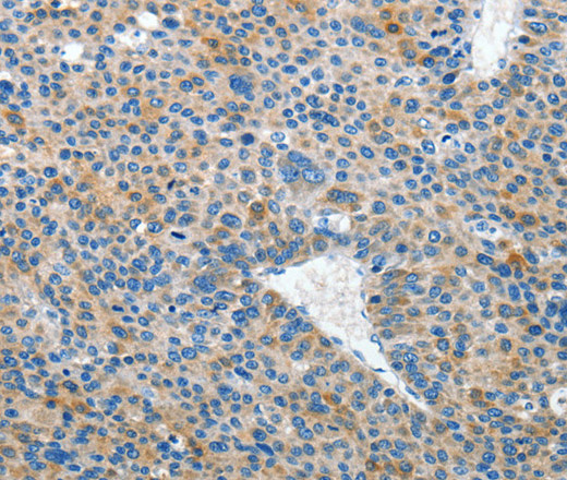 Immunohistochemistry of paraffin-embedded Human liver cancer tissue using EPHB3 Polyclonal Antibody at dilution 1:50