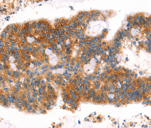 Immunohistochemistry of paraffin-embedded Human colon cancer tissue using AFDN Polyclonal Antibody at dilution 1:40