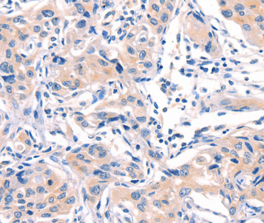 Immunohistochemistry of paraffin-embedded Human lung cancer tissue using AFDN Polyclonal Antibody at dilution 1:40