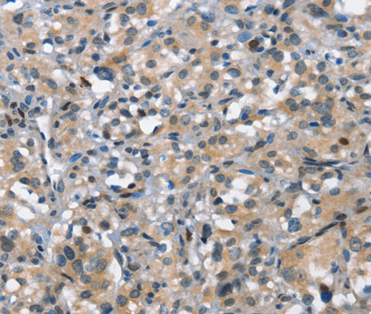 Immunohistochemistry of paraffin-embedded Human thyroid cancer tissue using DDR2 Polyclonal Antibody at dilution 1:40