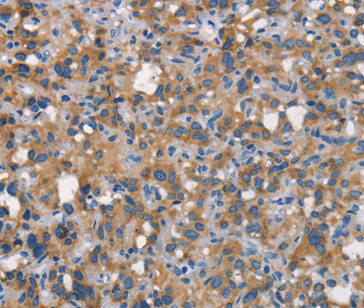 Immunohistochemistry of paraffin-embedded Human thyroid cancer tissue using CEACAM6 Polyclonal Antibody at dilution 1:70