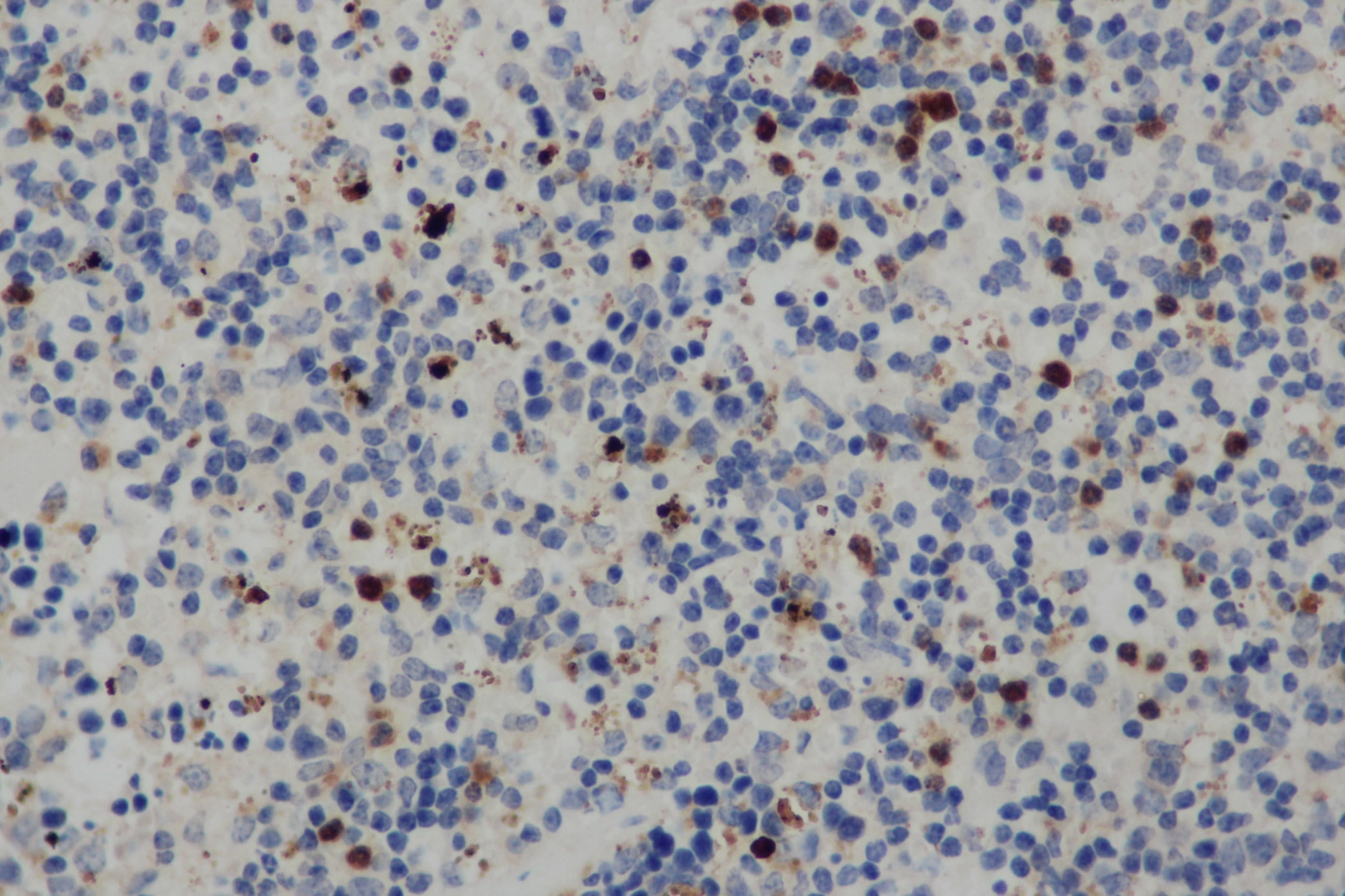 Immunohistochemistry of paraffin-embedded Human cervical cancer tissue using CD68 Polyclonal Antibody at dilution 1:30