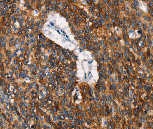 Immunohistochemistry of paraffin-embedded Human lung cancer tissue using CD68 Polyclonal Antibody at dilution 1:30