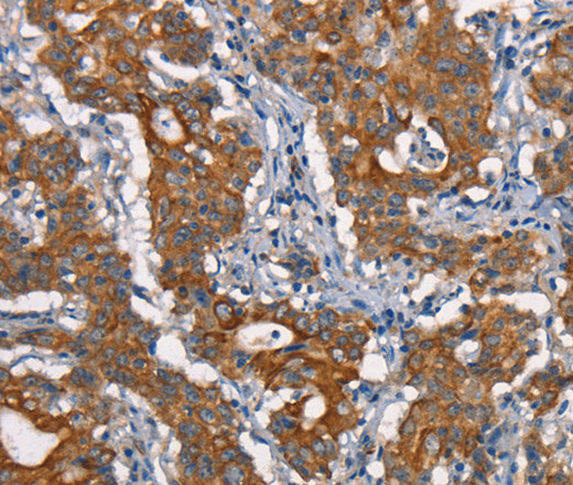 Immunohistochemistry of paraffin-embedded Human gasrtic cancer tissue using CDC23 Polyclonal Antibody at dilution 1:50