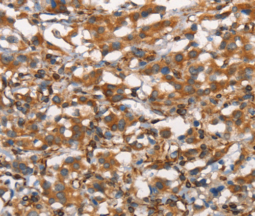 Immunohistochemistry of paraffin-embedded Human thyroid cancer tissue using CDC23 Polyclonal Antibody at dilution 1:50