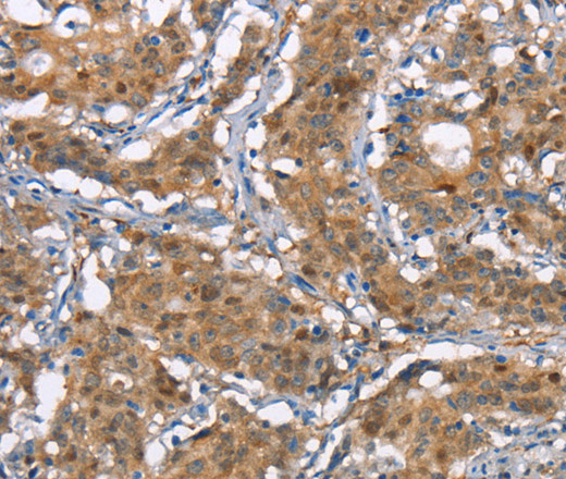 Immunohistochemistry of paraffin-embedded Human gastic cancer using CDC25A Polyclonal Antibody at dilution of 1:50