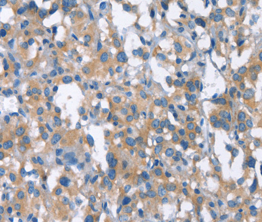 Immunohistochemistry of paraffin-embedded Human thyroid cancer using CDC25A Polyclonal Antibody at dilution of 1:50