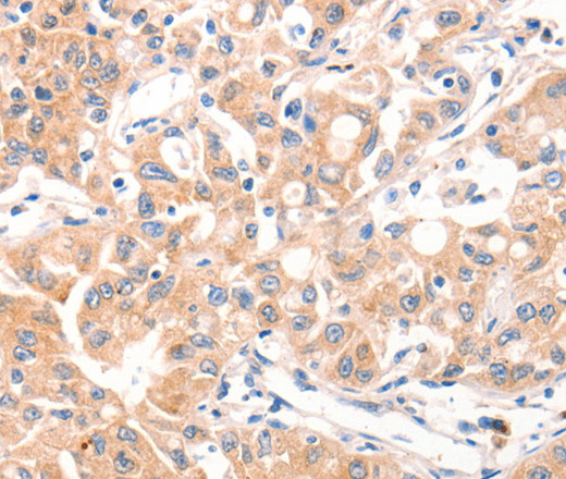 Immunohistochemistry of paraffin-embedded Human ovarian cancer tissue using MUC2 Polyclonal Antibody at dilution 1:60