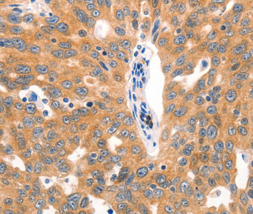 Immunohistochemistry of paraffin-embedded Human lung cancer tissue using MUC2 Polyclonal Antibody at dilution 1:60