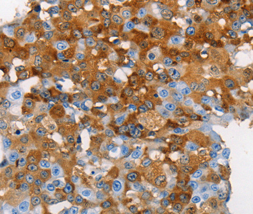 Immunohistochemistry of paraffin-embedded Human cervical cancer tissue using MUC5B Polyclonal Antibody at dilution 1:70