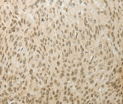 Immunohistochemistry of paraffin-embedded Human cervical cancer using MYSM1 Polyclonal Antibody at dilution of 1:60