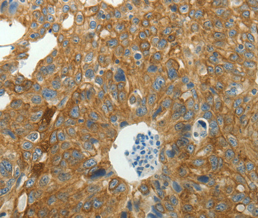 Immunohistochemistry of paraffin-embedded Human ovarian cancer tissue using NDRG2 Polyclonal Antibody at dilution 1:40