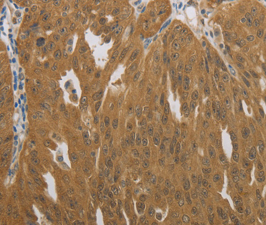 Immunohistochemistry of paraffin-embedded Human ovarian cancer using NIT2 Polyclonal Antibody at dilution of 1:40