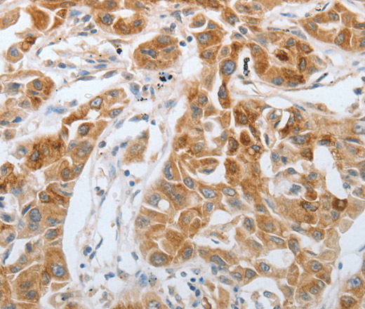 Immunohistochemistry of paraffin-embedded Human lung cancer using RTN4 Polyclonal Antibody at dilution of 1:40