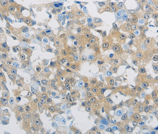 Immunohistochemistry of paraffin-embedded Human breast cancer tissue using CD303 Polyclonal Antibody at dilution of 1:70