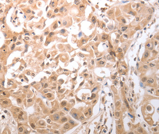 Immunohistochemistry of paraffin-embedded Human lung cancer tissue using HCRTR1 Polyclonal Antibody at dilution 1:100