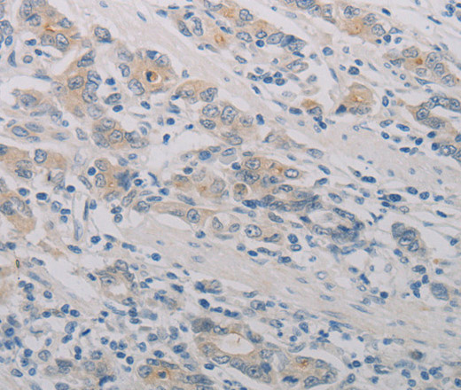 Immunohistochemistry of paraffin-embedded Human gasrtic cancer tissue using PTAFR Polyclonal Antibody at dilution 1:70