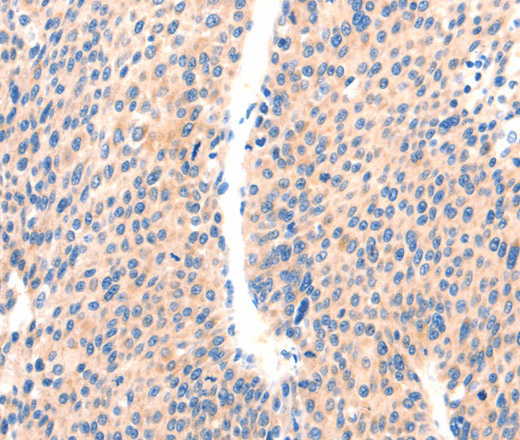 Immunohistochemistry of paraffin-embedded Human liver cancer using PAFAH2 Polyclonal Antibody at dilution of 1:80